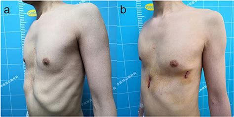 Frontiers A Modfied Nuss Procedure For Recurrent Pectus Excavatum Of Adults Surgery