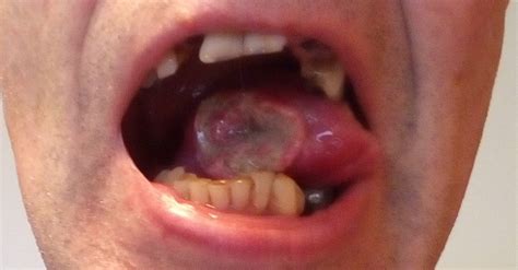 Oral Cancer A Story