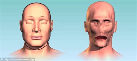 Dallas Wiens First Full Face Transplant Man Face Transplants