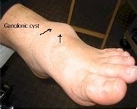Ganglionic Cysts Of The Foot Causes And Treatment Options Myfootshop Com