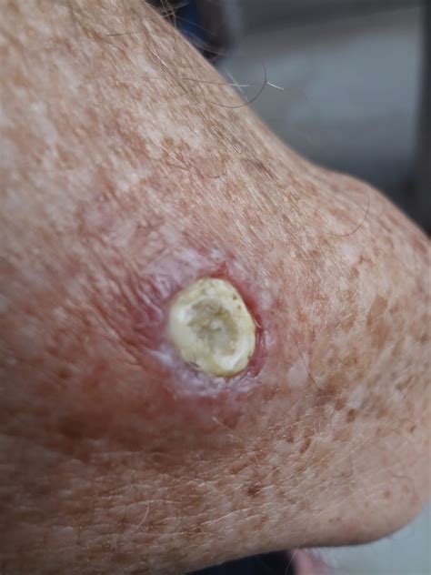 A wart on the sole of the foot, caused by a virus. Always Learning: Wonders Of Black Salve