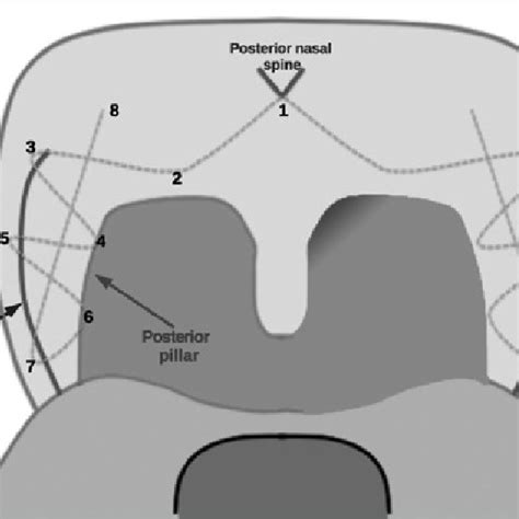 Incision And Releasing Of The Palatopharyngeal Musclearrows Full