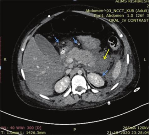 Pancreas Is Bulky In The Tail Region And Shows Ill Defined
