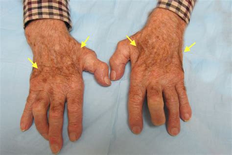 Ulnar Intrinsic Atrophy Hand Surgery Resource