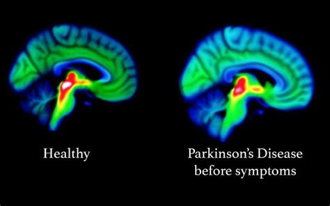 Parkinsons Disease Spotted In Brain More Than A Decade Before Symptoms