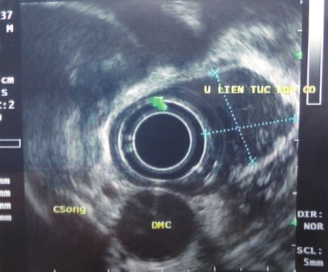 Image Of Esophageal Duplication Cyst On Esophageal Endoscopic