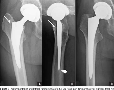 Figure 2 From New Approach And Stem Increased Femoral Revision Rate In