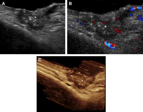 Basal Cell Carcinoma Left Paranasal Region A Gray Scale Ultrasound