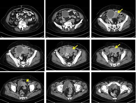 Endometrioid Carcinoma Of Uterine Corpus Radiology Cases