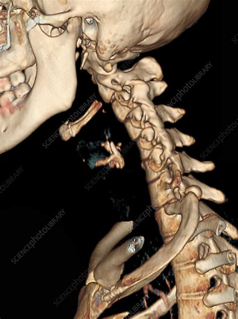 Straight Cervical Spine Ct Scan Stock Image M3301502