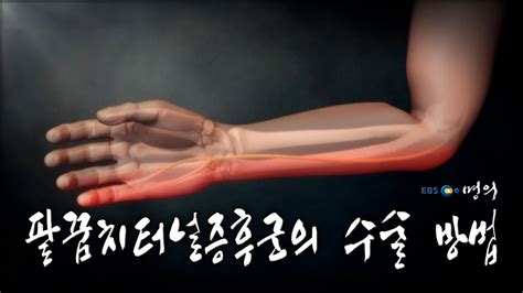 명의 의학백과📖 팔꿈치터널증후군의 수술 방법 Youtube
