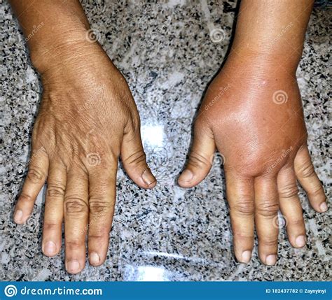 Comparison Of Normal Right Hand To Left Swollen And Red Hand Caused By