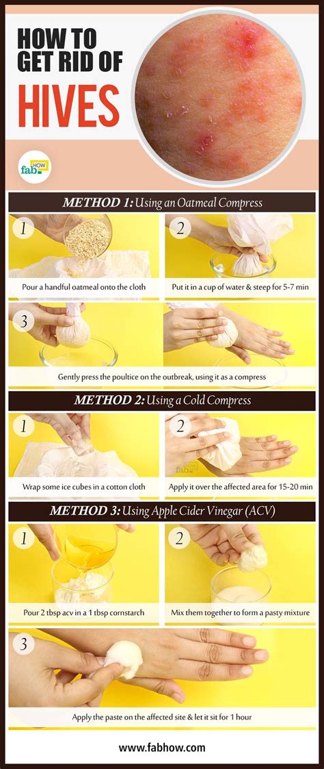 22 Best Hives Images On Pinterest Hives Remedies Natural Home