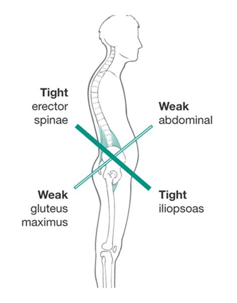 How To Fix Lower Crossed Syndrome