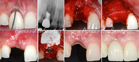 Espícula óssea Osso Exposto Após Extração De Dente