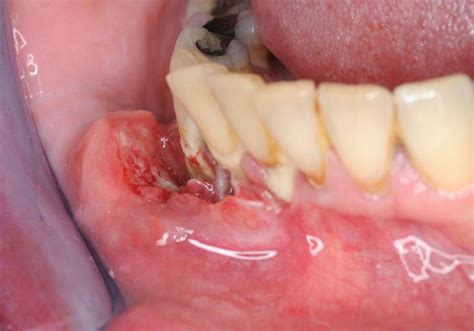 A Squamous Cell Carcinoma Of The Lower Gum Mr Luke Cascarini