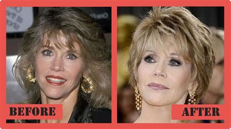 Jane Fonda Before And After Plastic Surgery 03 Celebr