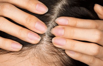 Things To Know Saf Scarring Alopecia Foundation
