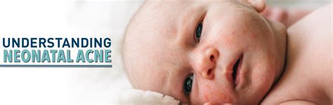 Understanding Neonatal Acne Masters Of Pediatrics