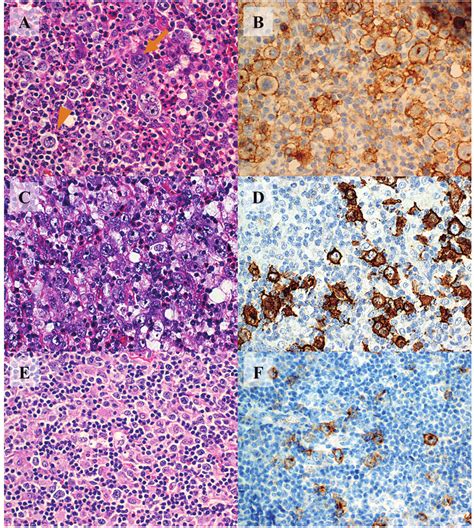 Cd30 Immunohistochemical Staining In Hl Alcl And Reactive
