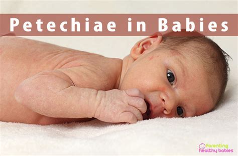 Petechiae In Babies Things Every New Mom Should Know