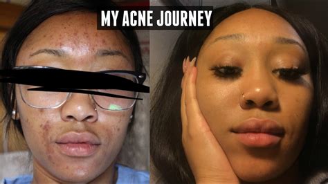 My Accutane Experience Before And After Pics Products Used Side
