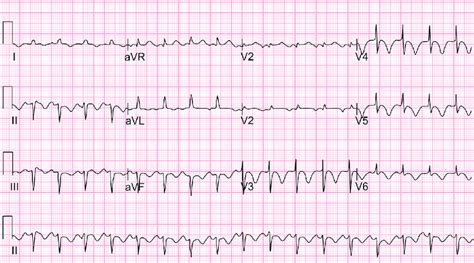 Ecg Electrocardiogram Showing Global St Segment Depression And T