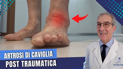 Artrosi Della Caviglia Cause Sintomi E Cure Artrosi Post Traumatica