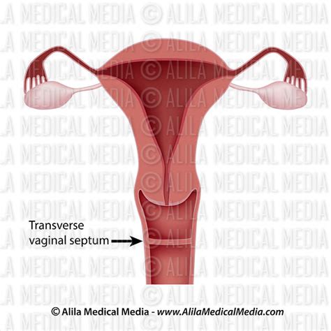 Alila Medical Media Transverse Vaginal Septum Medical Illustration