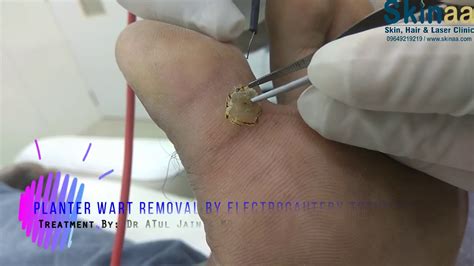 Wart Removal Plantar Wart Removal On The Bottom Of A Foot By