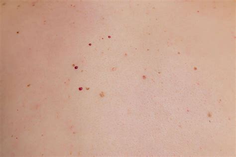 Red Spots On Skin Cancer