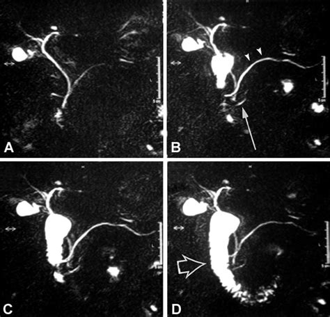 Pancreas Divisum Evaluation With Secretin Enhanced Magnetic Resonance