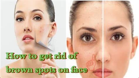 Home Remedies Brown Spots On Face