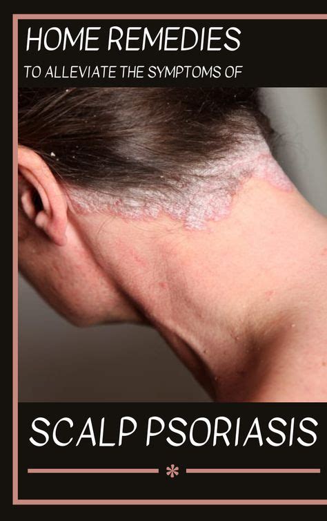 Home Remedies To Alleviate The Symptoms Of Scalp Psoriasis Scalp