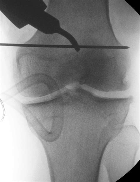 Medial Closing Wedge Distal Femoral Osteotomy Fixation With Proximal