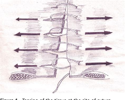 Figure 1 From Reinforced Tension Line Suture Closure After Midline