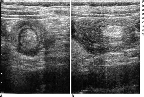 Figure 1 From Us Features Of Transient Small Bowel Intussusception In