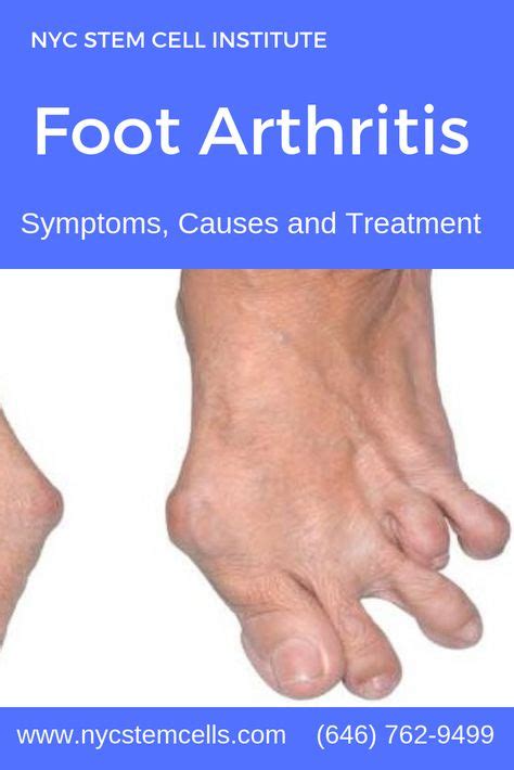 Foot And Ankle Osteoarthritis