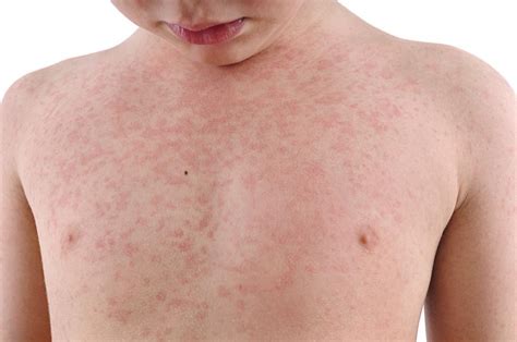 Rubella German Measles Symptoms Treatment During