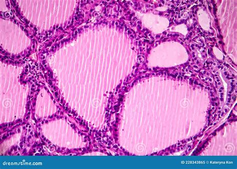 Toxic Diffuse Goiter Or Graves Disease Light Micrograph Stock Image