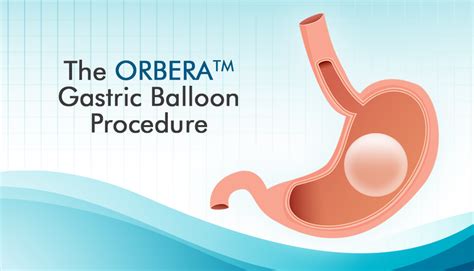 7 Things To Know About The Orbera Gastric Balloon Procedure Obesityhelp