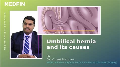 Umbilical Hernia Causes Symptoms And Treatments Otosection