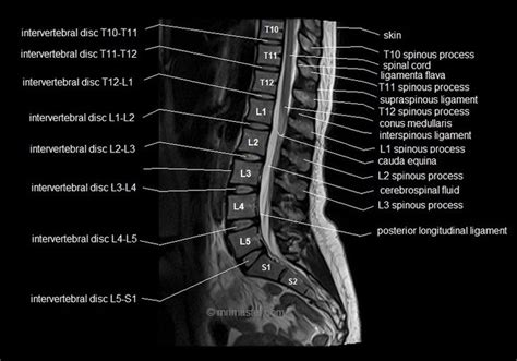 MRI spine anatomy | free MRI lumbar spine sagittal cross sectional