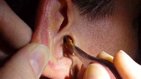 Top Remedies To Get Rid Of Clogged Ear Easily Youtube