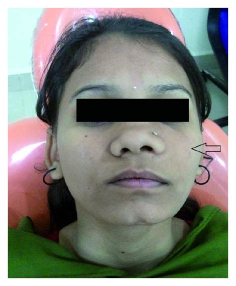 Preoperative Frontal View Showing Swelling On Left Side Of The Face