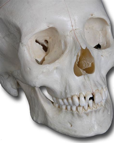 Wikipedia explains why there is a however, such discrepancies between various sources are only differences in how to classify and/or. How Many Bones In The Face And Head - Bones Of The Face Joi Jacksonville Orthopaedic Institute ...