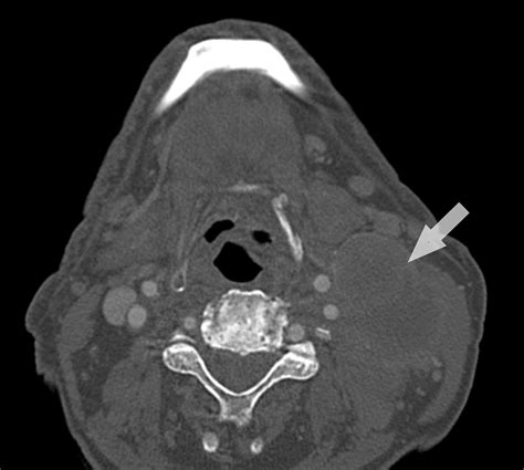 Cureus Carotid Sinus Syndrome In A Patient With Head And Neck Cancer