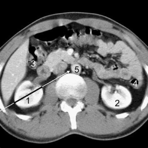 Abdominal Ct Scan At The Level Of The Lower Pole Of Kidneys In A Male