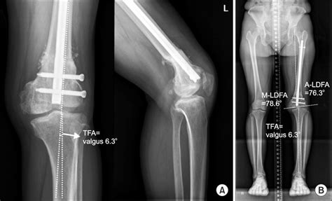 Plain Radiography After 6 Months Later Deformity Correction By