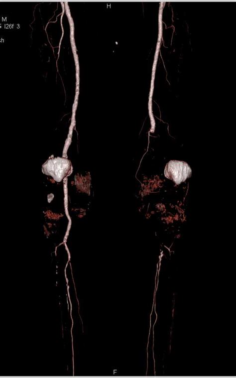 Peripheral Vascular Disease Pvd With Left Superficial Femoral Artery